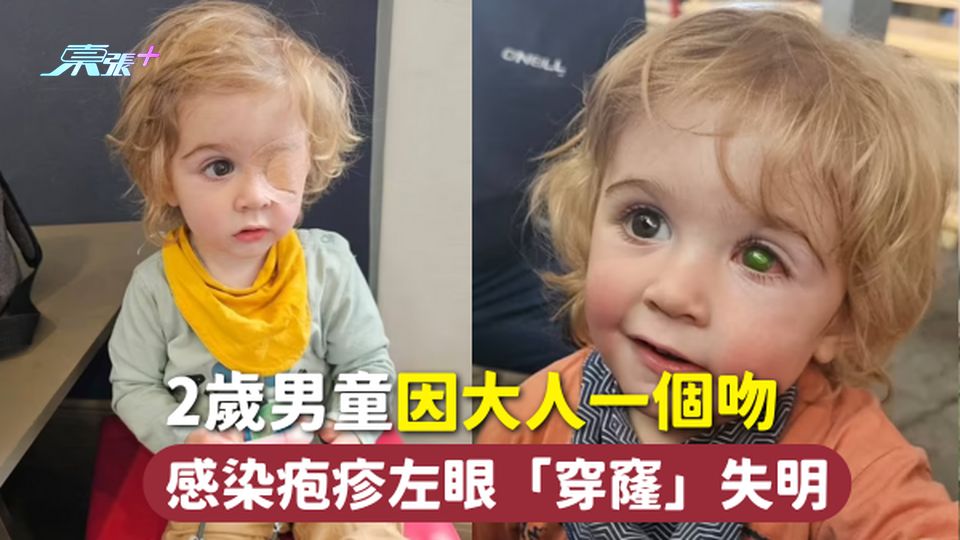 家長注意 | 2歲男童因大人一個吻 感染疱疹左眼「穿窿」失明