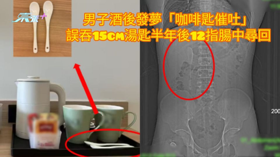 男子酒後發夢「咖啡匙催吐」 誤吞15cm湯匙半年後12指腸中尋回