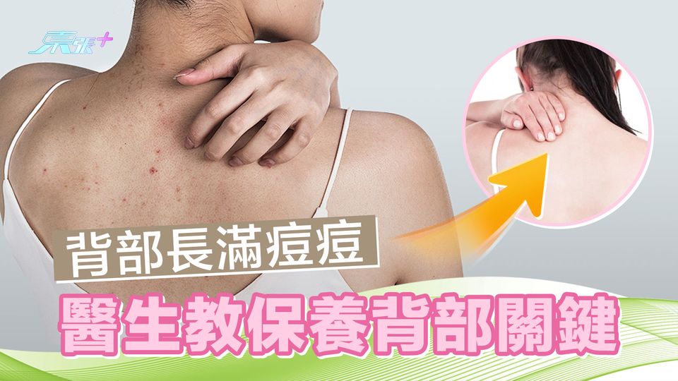 背部長滿痘痘 醫生教保養背部關鍵 