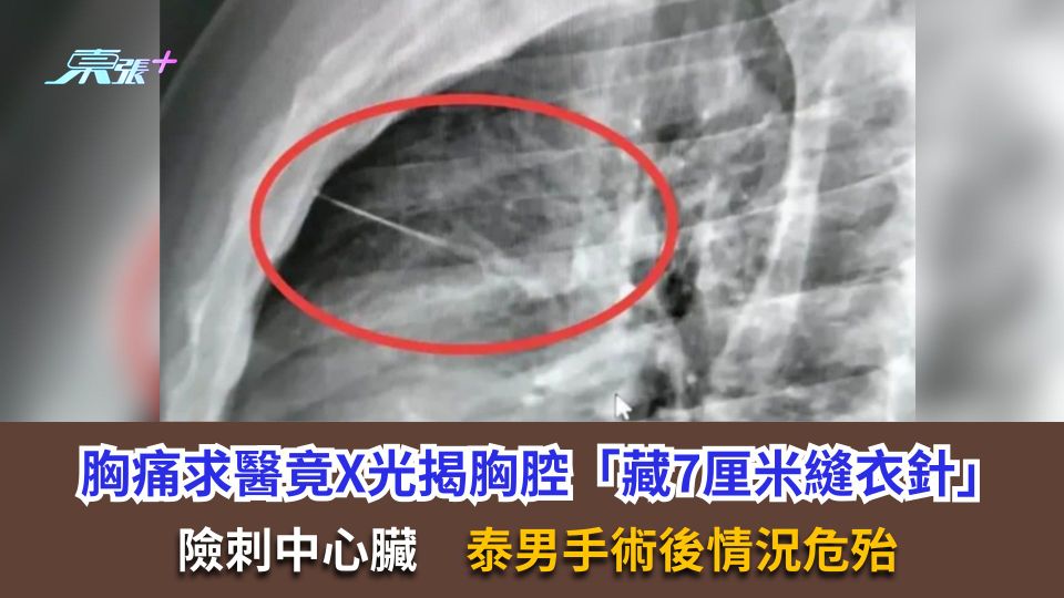 胸痛求醫竟X光揭胸腔「藏7厘米縫衣針」　險刺中心臟　泰男手術後情況危殆