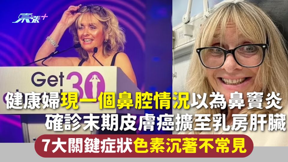 皮膚癌 | 健康婦現一個鼻腔情況以為鼻竇炎 確診末期皮膚癌擴至乳房肝臟 7大關鍵症狀 色素沉著不常見