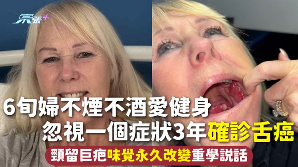 舌癌 | 6旬婦不煙不酒愛健身 忽視一個症狀3年確診舌癌 頸留巨疤味覺永久改變重學說話