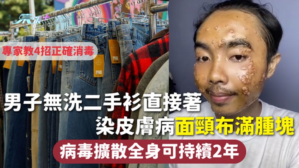 衣物危機 | 男子無洗二手衫直接著 染皮膚病面頸布滿腫塊 病毒擴散全身可持續2年 專家教4招正確消毒
