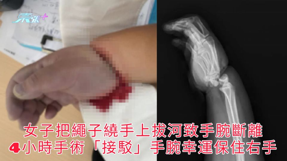 恐怖拔河 | 女子把繩子繞手上拔河致手腕斷離 4小時手術「接駁」手腕幸運保住右手