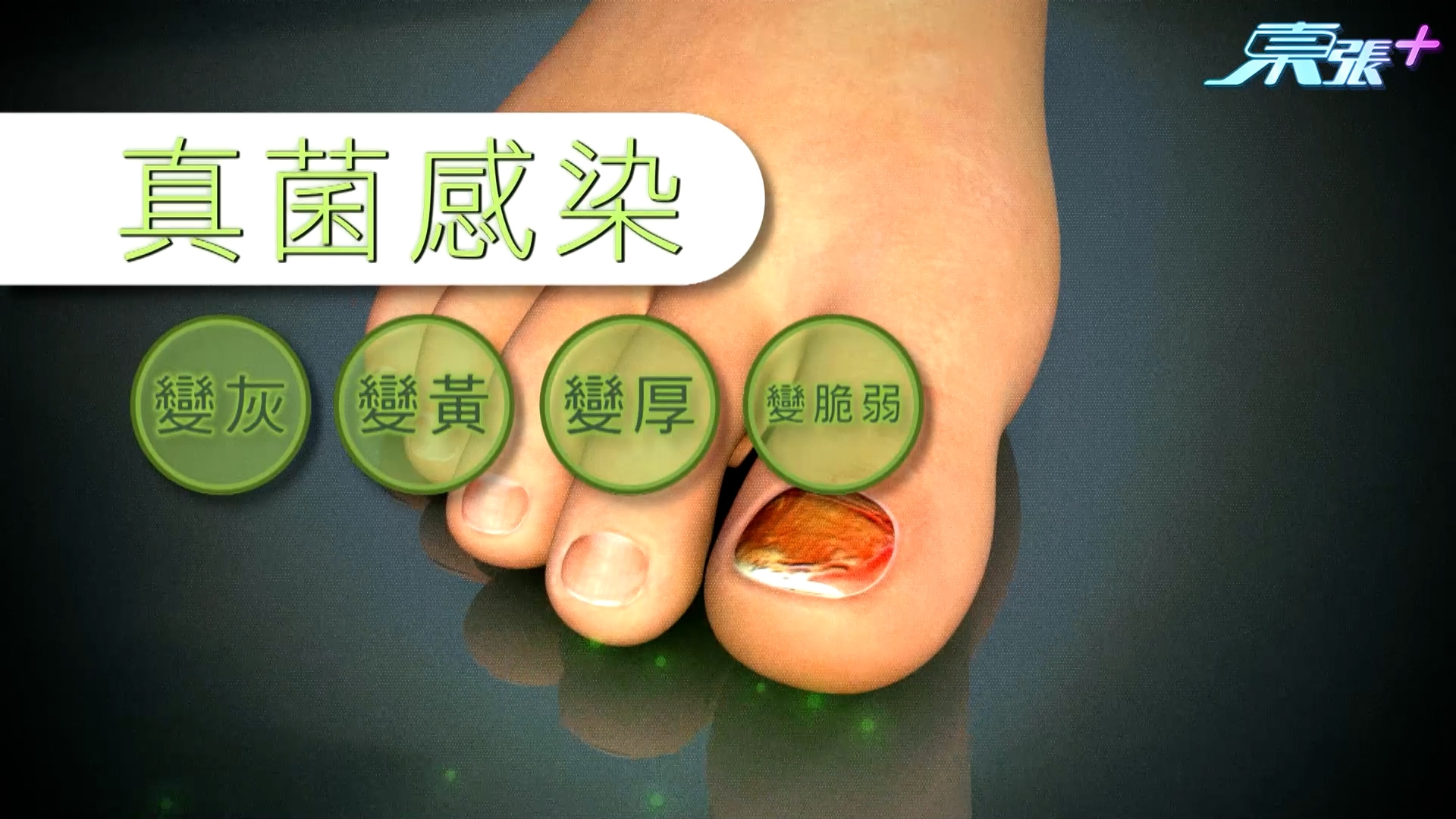 當真菌入侵甲床，會令指甲變灰黃、增厚及脆弱，甚至粉碎成粉狀。