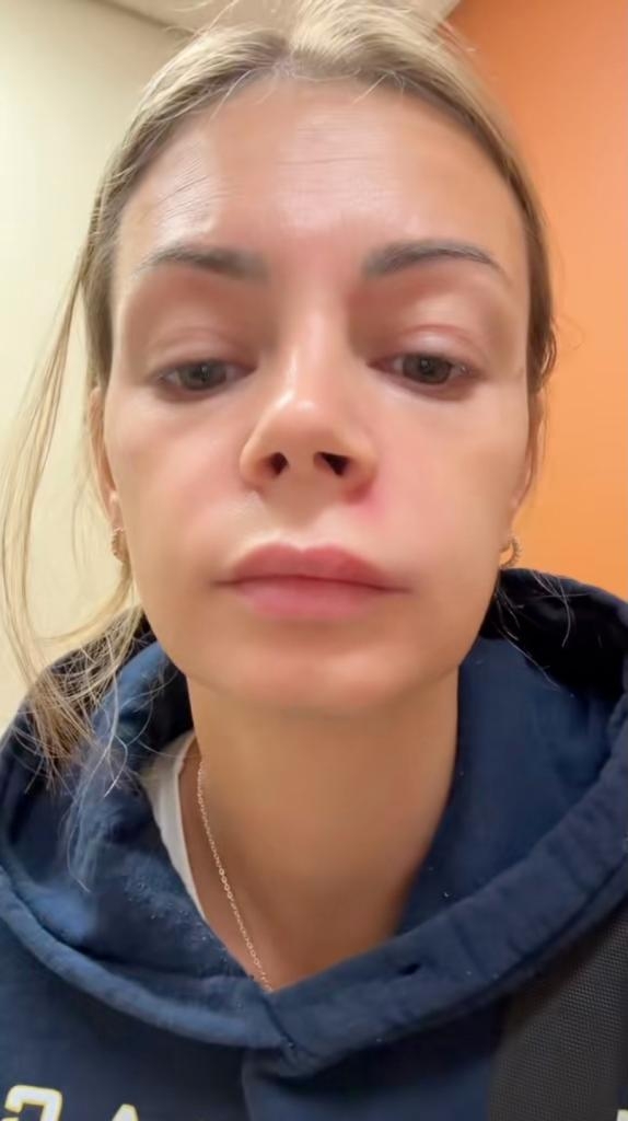 莉許瑪莉 (Lish Marie) 警告人們不要擠位於「死亡三角區」的一顆痘痘，因為她自己也因此被緊急送往醫院。