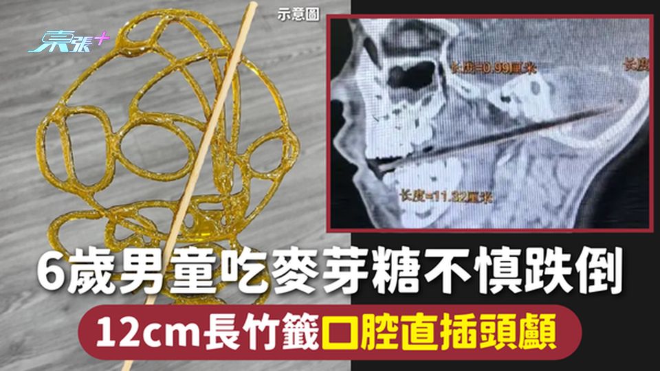 家長注意 | 6歲男童吃麥芽糖不慎跌倒 12cm長竹籤口腔直插頭顱 
