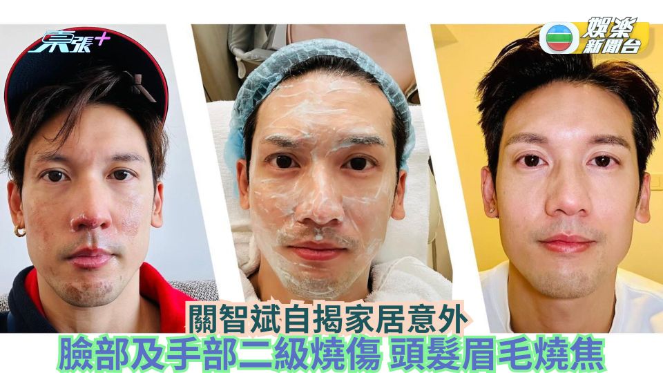 關智斌自揭家居意外 臉部及手部二級燒傷 頭髮眉毛燒焦