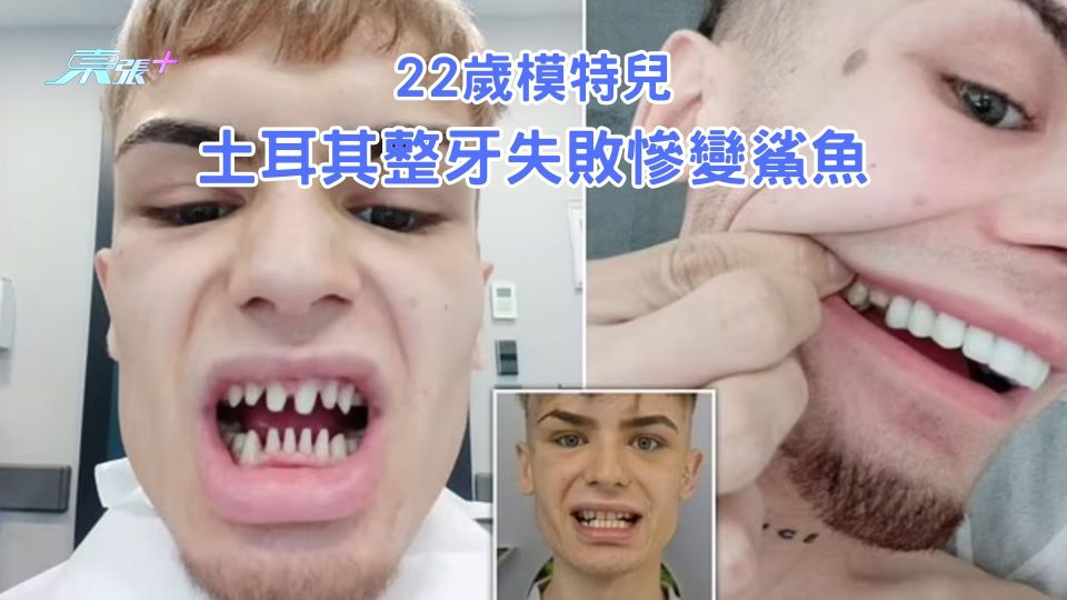 22歲模特兒去土耳其整牙失敗慘變鯊魚