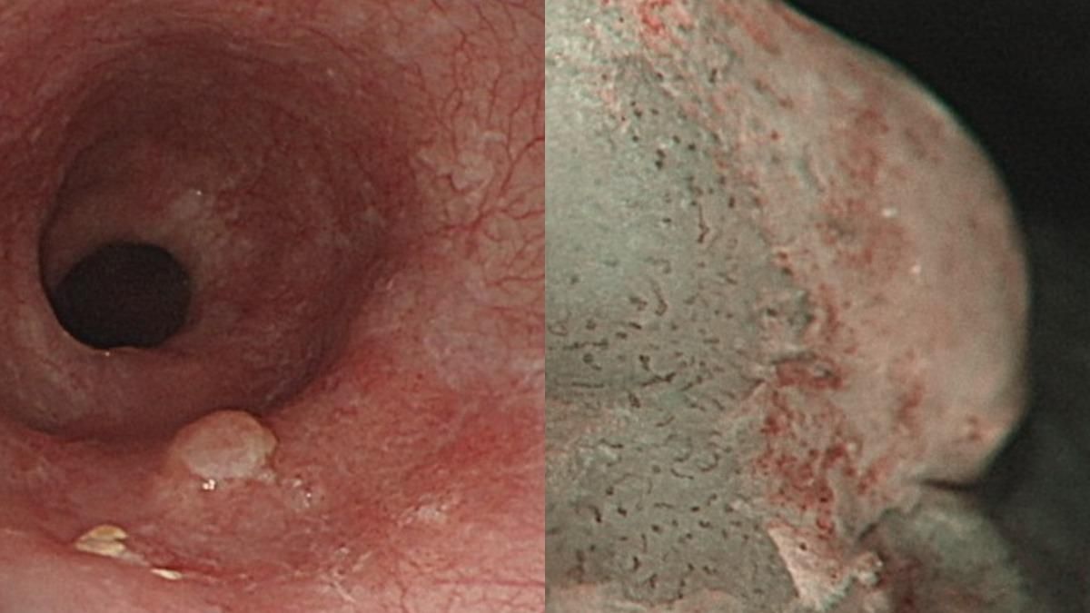 戴男中段食道有約莫2 公分異常發紅病灶（左）、食道瘜肉（右）。（圖／烏日林新提供）