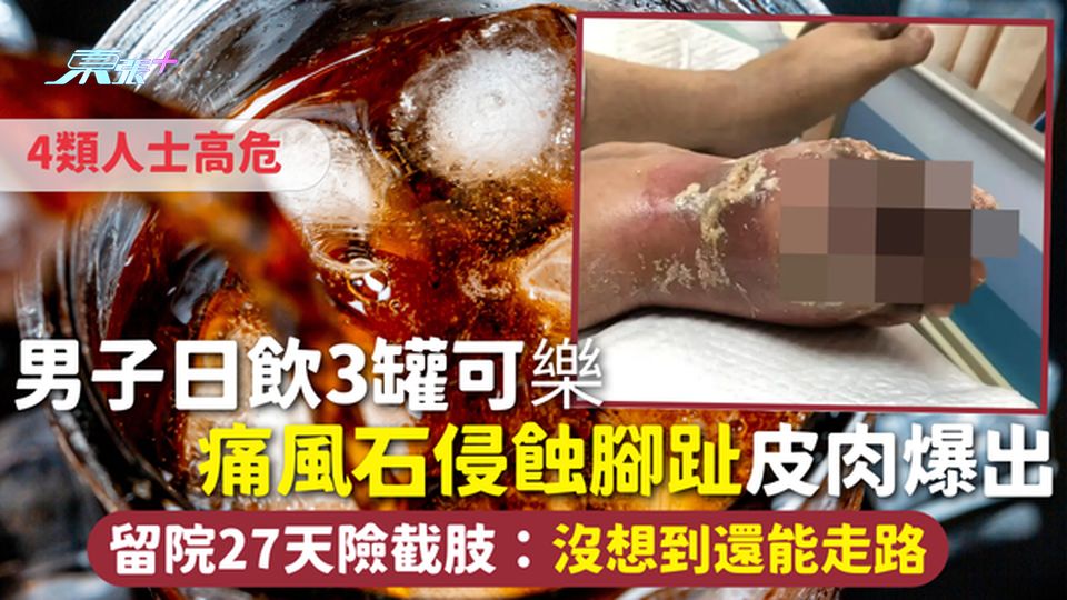 痛風 | 男子日飲3罐可樂 痛風石侵蝕腳趾皮肉爆出 留院27天險截肢：沒想到還能走路 4類人高危