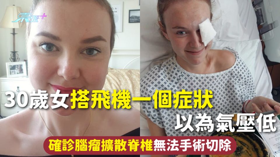 腦瘤 | 30歲女搭飛機一個症狀以為氣壓低 確診腦瘤擴散脊椎無法手術切除