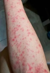 文中指，感染後可能出現39度以上持續高燒、劇烈關節疼痛、皮疹等症狀，部分患者甚至會發展為慢性病痛或嚴重併發症，嚴重影響健康和生活質量。