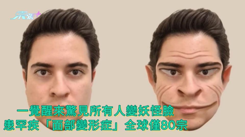 一覺醒來驚見所有人變妖怪臉 患罕疾「面部變形症」全球僅80宗