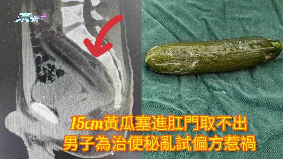 15cm黃瓜塞進肛門取不出 男子為治便秘亂試偏方惹禍