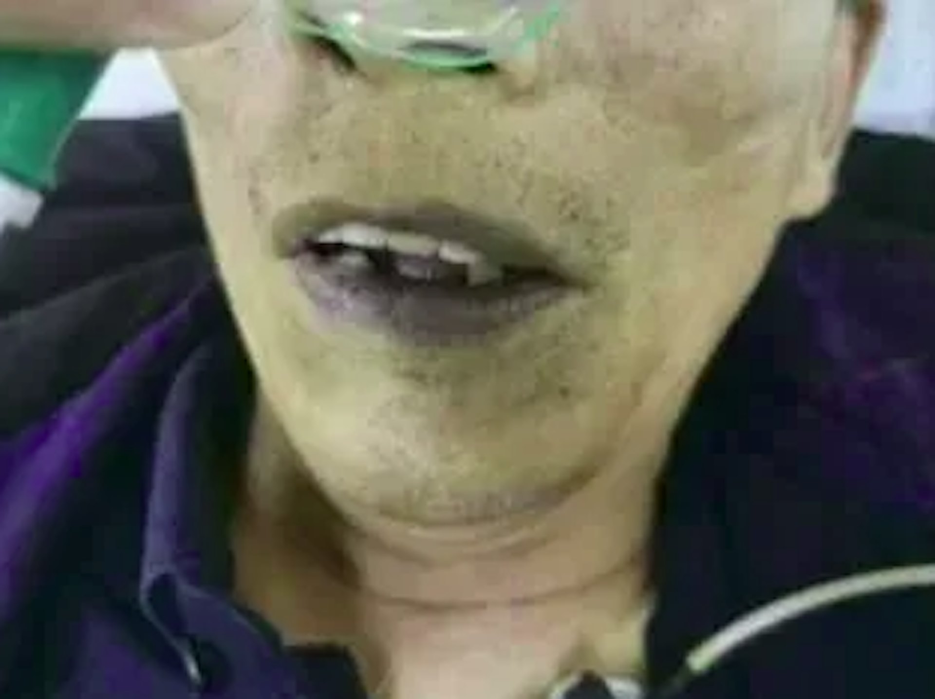 王先生嘴唇和指甲青紫得像塗了藍墨水。（網上圖片）