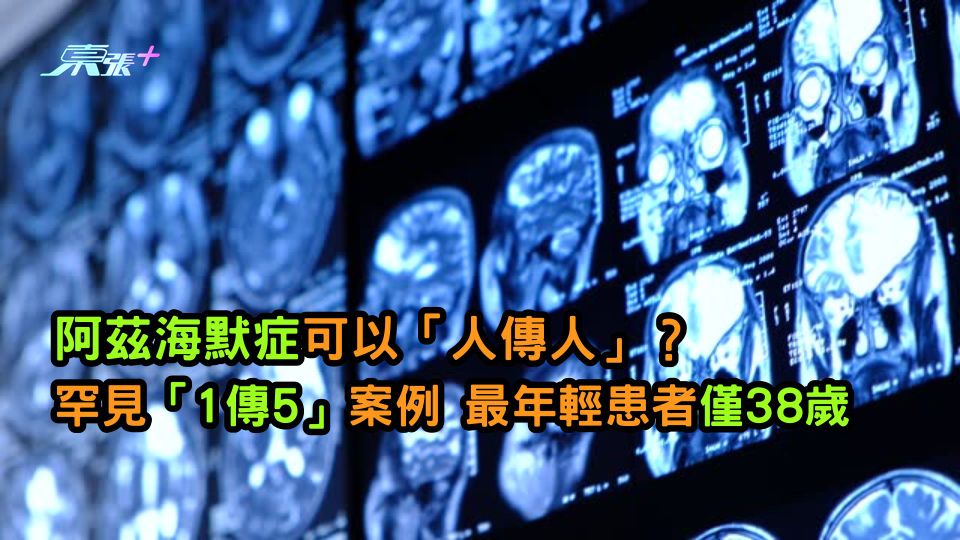 阿茲海默症可以「人傳人」？ 罕見「1傳5」案例 最年輕患者僅38歲