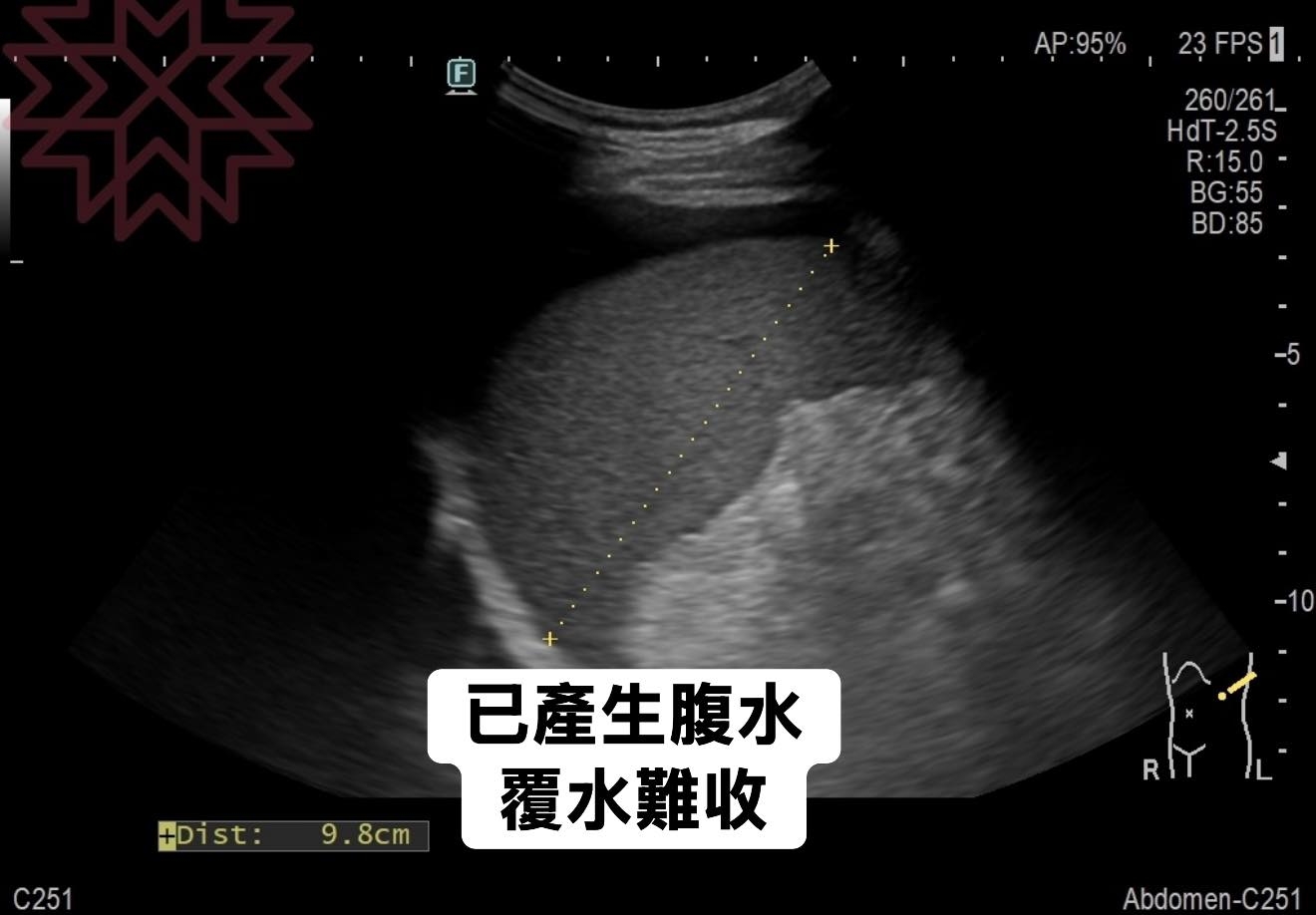 May be an image of ‎xray and ‎text that says '‎ح AP:95% :95% 23 23FPS1 FPS 260/ 260/261_ 261_ HdT-2.5S .5S R:15.0- BG:55 55 BG BD:85 -5 C251 #Dist:9.8cm +Dist: 9.8cm 已產生腹水 覆水難收 RIT Abdomen-C251‎'‎‎