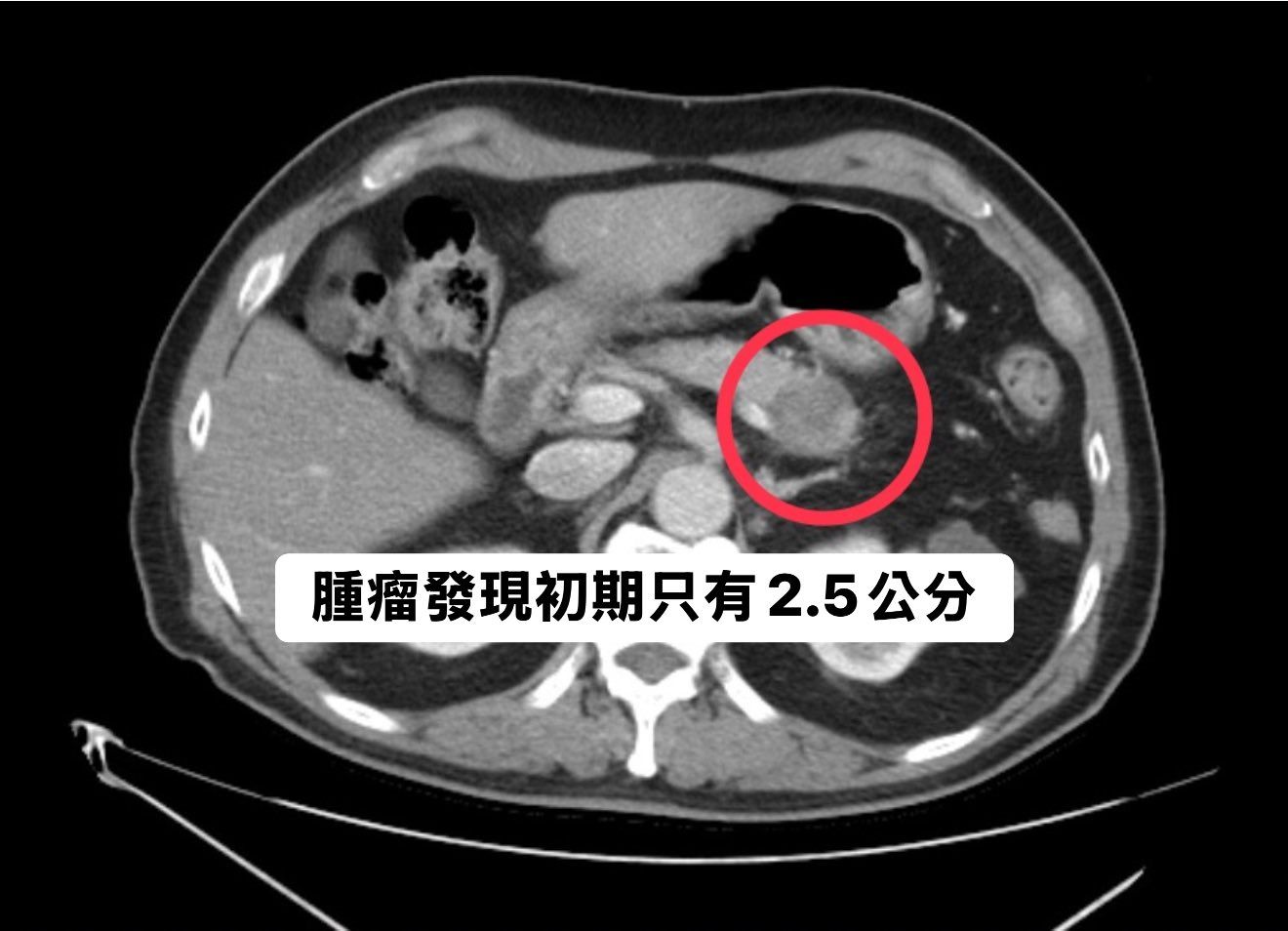 May be an image of xray and text that says '腫瘤發現初期只有2.5公分 2.5公分'