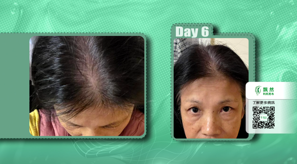 用家曾女士分享：告別化學過敏　昆布配方更安心