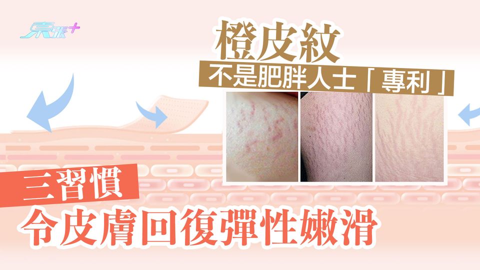 橙皮紋不是肥胖人士「專利」 三習慣令皮膚回復彈性嫩滑