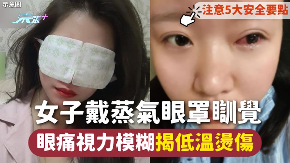 低溫燙傷 | 女子戴蒸氣眼罩瞓覺 眼痛視力模糊揭低溫燙傷 注意5大安全要點