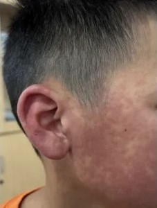 佛山三水區發文，提醒民眾關於基孔肯雅熱的後遺症與防疫措施。