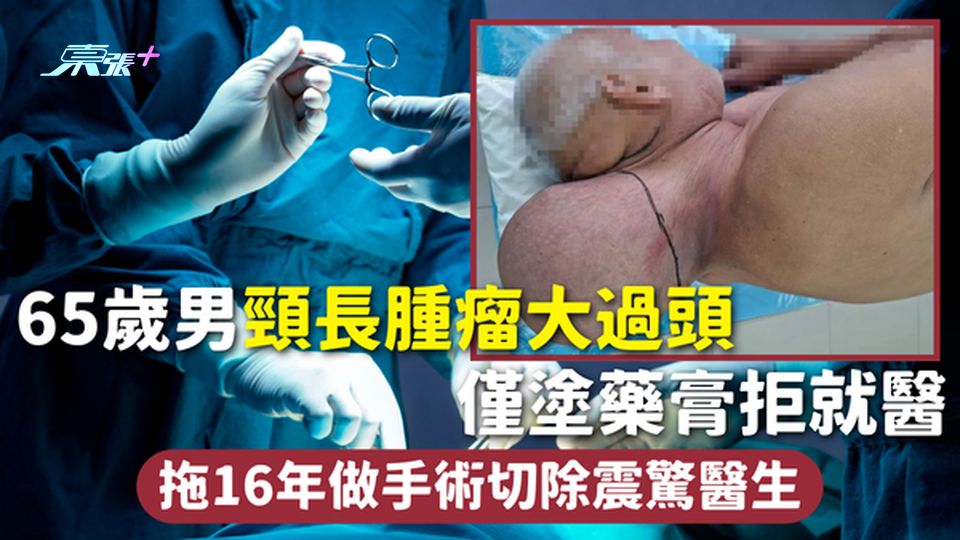 巨大腫瘤 | 65歲男頸長腫瘤大過頭 僅塗藥膏拒就醫 拖16年做手術切除震驚醫生【有圖】