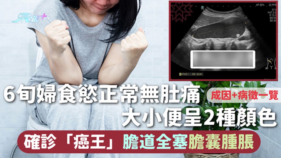 胰臟癌 | 6旬婦食慾正常無肚痛 大小便呈2種顏色 確診「癌王」膽道全塞膽囊腫脹 成因+病徵一覽