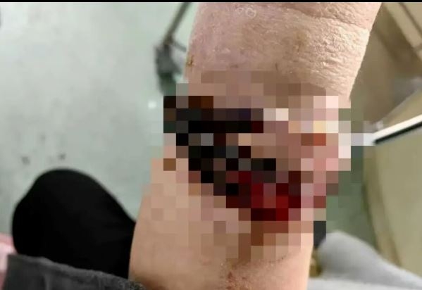 一名女子手腕上的佛珠已戴將近10年未曾取下，隨著體重增加，手鐲越來越緊，竟嵌入皮膚，難以自行摘除。（圖／翻攝微博極目新聞）