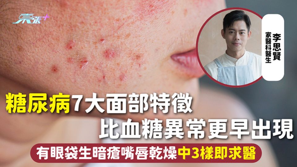 糖尿病 | 7大面部特徵 比血糖異常更早出現 有眼袋生暗瘡嘴唇乾燥中3樣即求醫