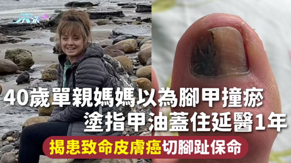 皮膚癌 | 40歲單親媽媽以為腳甲撞瘀 塗指甲油蓋住延醫1年 揭患致命皮膚癌切腳趾保命