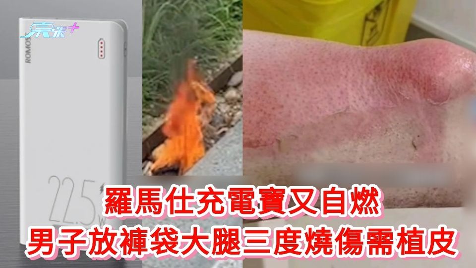 有片丨羅馬仕充電寶又自燃 男子放褲袋大腿三度燒傷需植皮