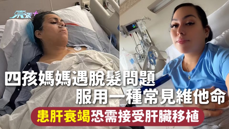 維他命 | 四孩媽媽遇脫髮問題 服用一種常見維他命 患肝衰竭恐需接受肝臟移植