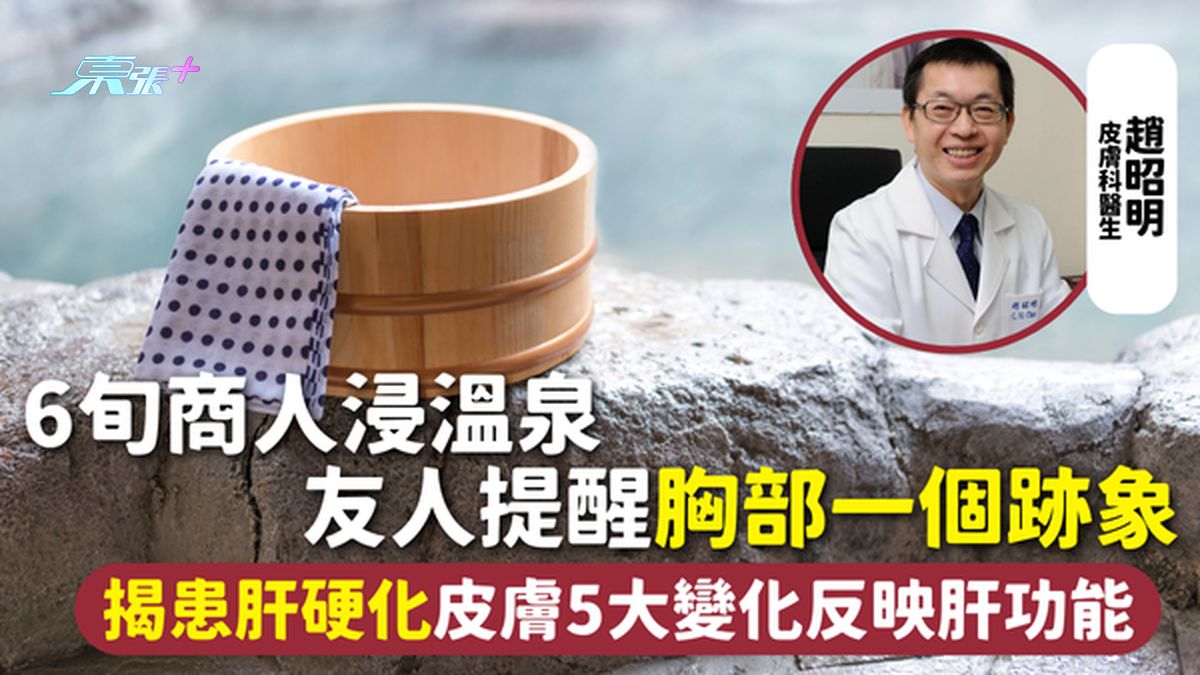 肝硬化 | 6旬商人浸温泉 友人提醒胸部一个迹象 揭患肝硬化皮肤5大变化反映肝功能