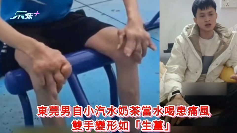 有片|東莞男自小汽水奶茶當水喝患痛風  雙手變形如「生薑」
