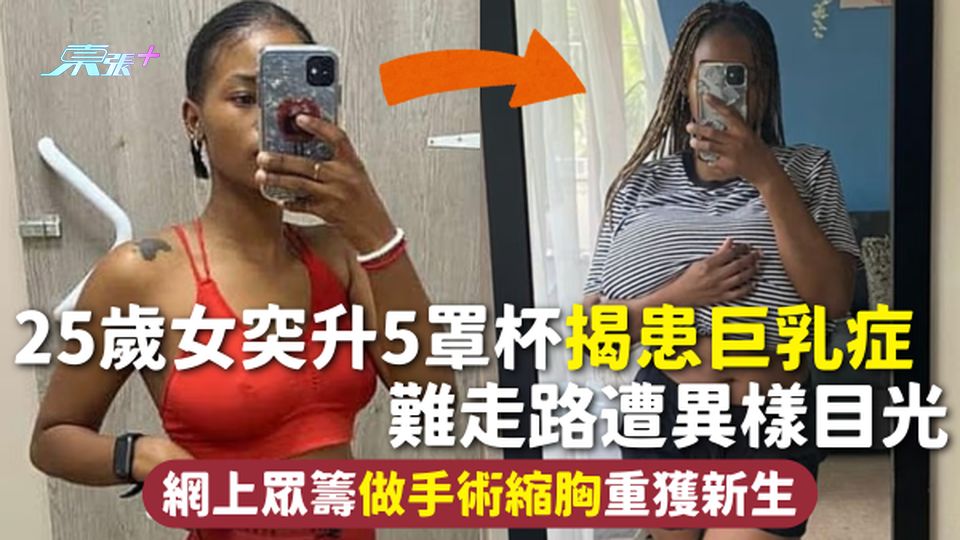 巨乳症 | 25歲女突升5罩杯揭患巨乳症 難走路遭異樣目光 網上眾籌做手術縮胸重獲新生