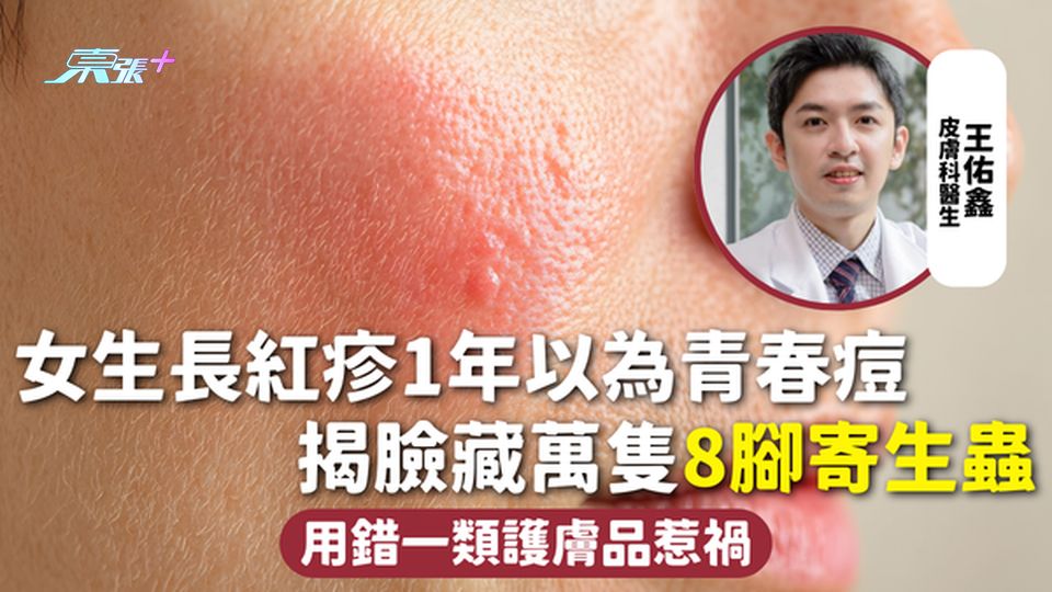 臉部皮膚 | 女生長紅疹1年以為青春痘 揭臉藏萬隻8腳寄生蟲 用錯一類護膚品惹禍