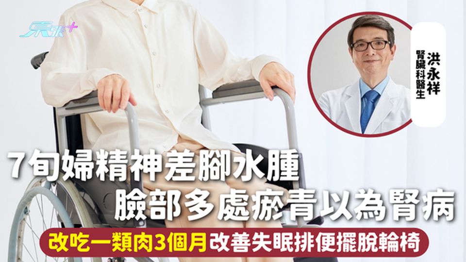 肌少症 | 7旬婦精神差腳水腫 臉部多處瘀青以為腎病 改吃一類肉3個月改善失眠排便擺脫輪椅