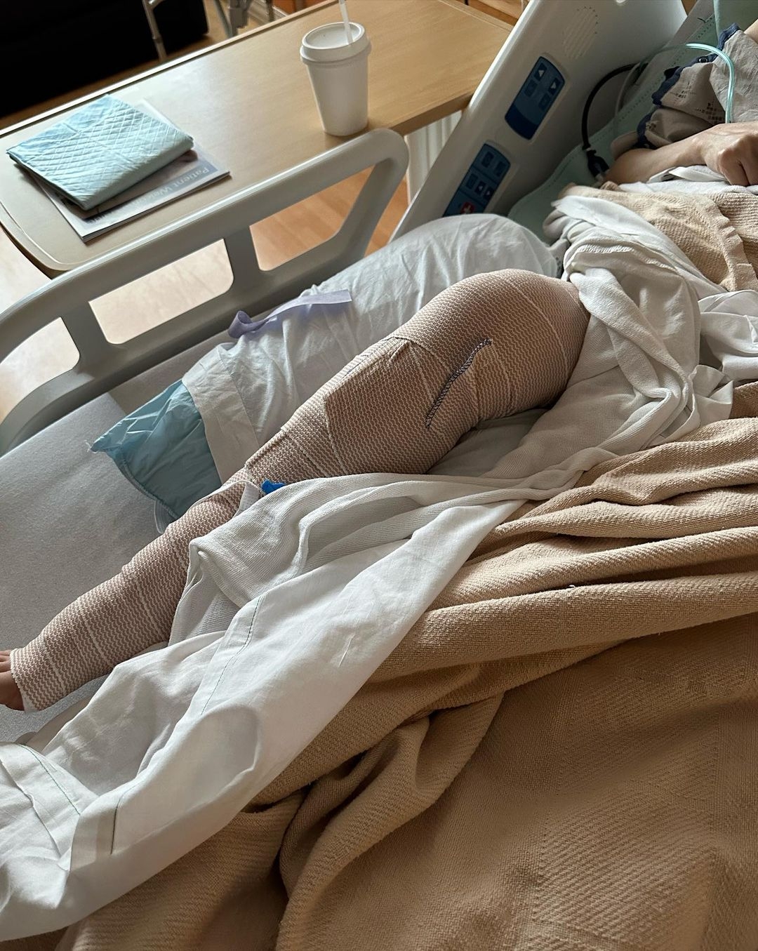 劉美君要用骨釘及骨髓內釘把破裂骨頭固定住，再等其慢慢康復。