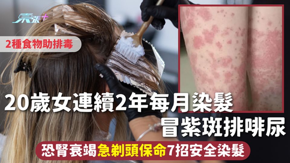 染髮危機 | 20歲女連續2年每月染髮 冒紫斑排啡尿 恐腎衰竭急剃頭保命 7招安全染髮2種食物助排毒