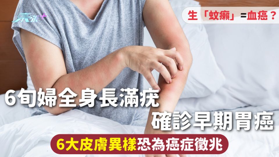 皮膚疾病 | 6旬婦全身長滿疣 確診早期胃癌 6大皮膚異樣恐為癌症徵兆 生「蚊癩」=血癌？