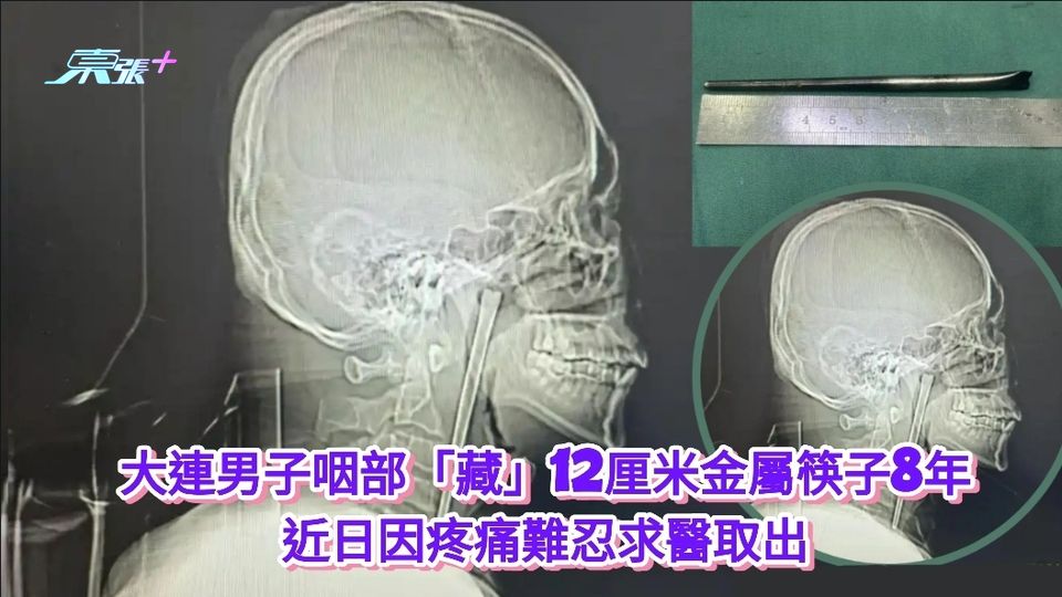 大連男子咽部「藏」12厘米金屬筷子8年  近日因疼痛難忍求醫取出