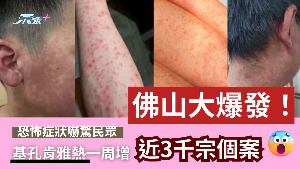 基孔肯雅熱｜佛山患者恐怖後遺症全曝光　皮疹爛面、部分或致嚴重併發症