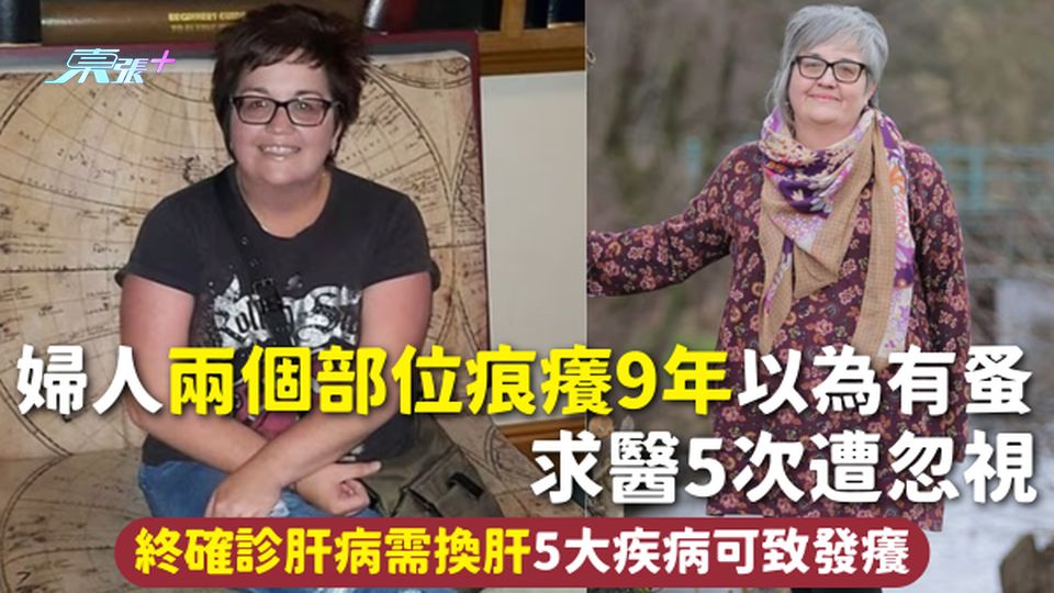 肝病 | 婦人兩個部位痕癢9年以為有蚤 求醫5次遭忽視 終確診肝病需換肝 5大疾病可致發癢
