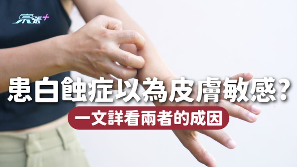 患白蝕症以為皮膚敏感，兩者成因大不同！白蝕症具傳染性嗎？