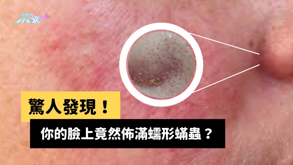 驚人發現！你的臉上竟然有蠕形蟎蟲？#至識健康