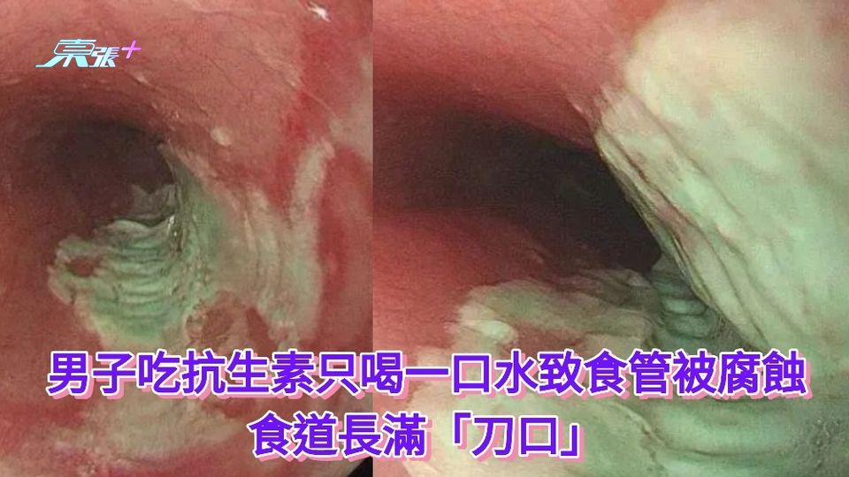 有片丨男子吃抗生素只喝一口水致食管被腐蝕 食道長滿「刀口」