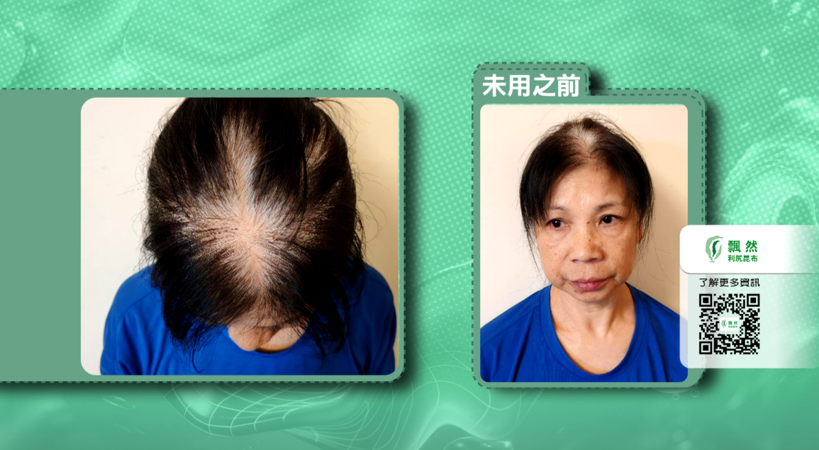 用家曾女士分享：告別化學過敏　昆布配方更安心