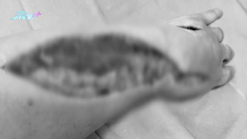 街市畀魚拮親手染食肉菌 動三次恐怖大手術切除腐肉死裡逃生